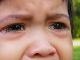 Điều trị sưng mí mắt ở trẻ em